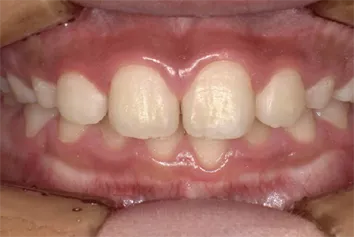 初期う蝕から2週間後にエナメル質の結晶が戻った