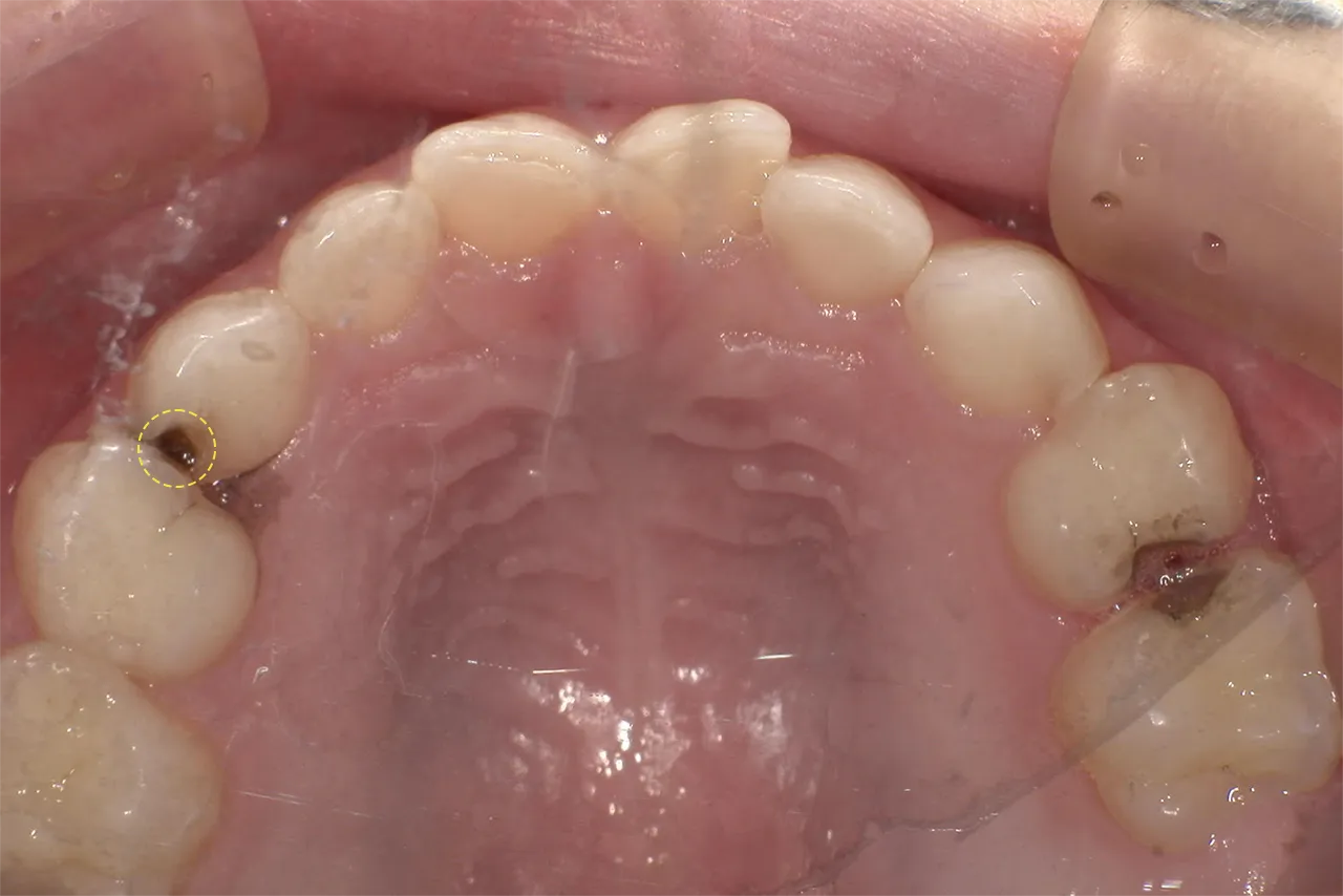 歯に穴があいている