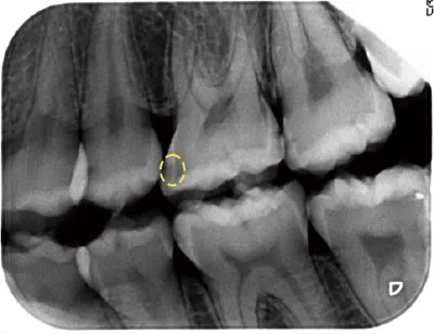レントゲンに写った虫歯