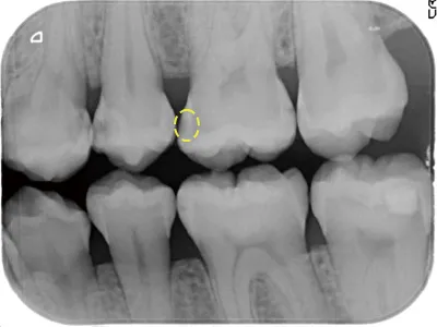 レントゲンに写った虫歯の進行が停止