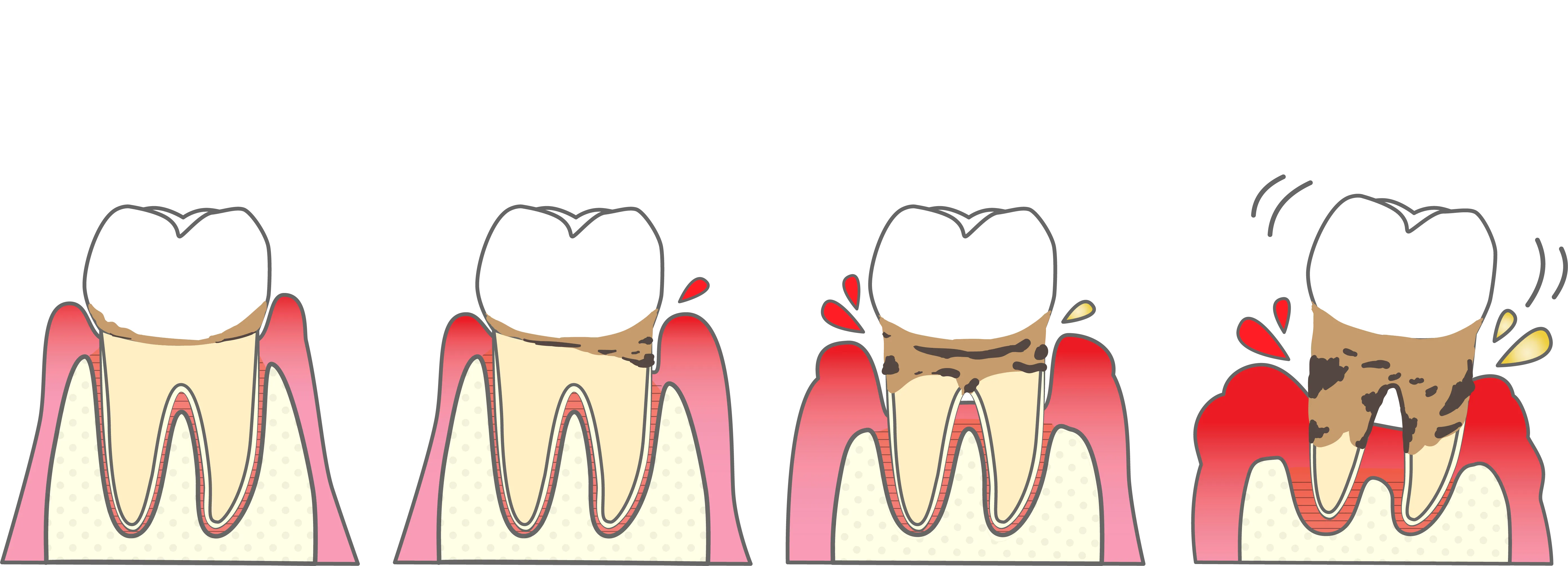 歯周病の進行のイラスト