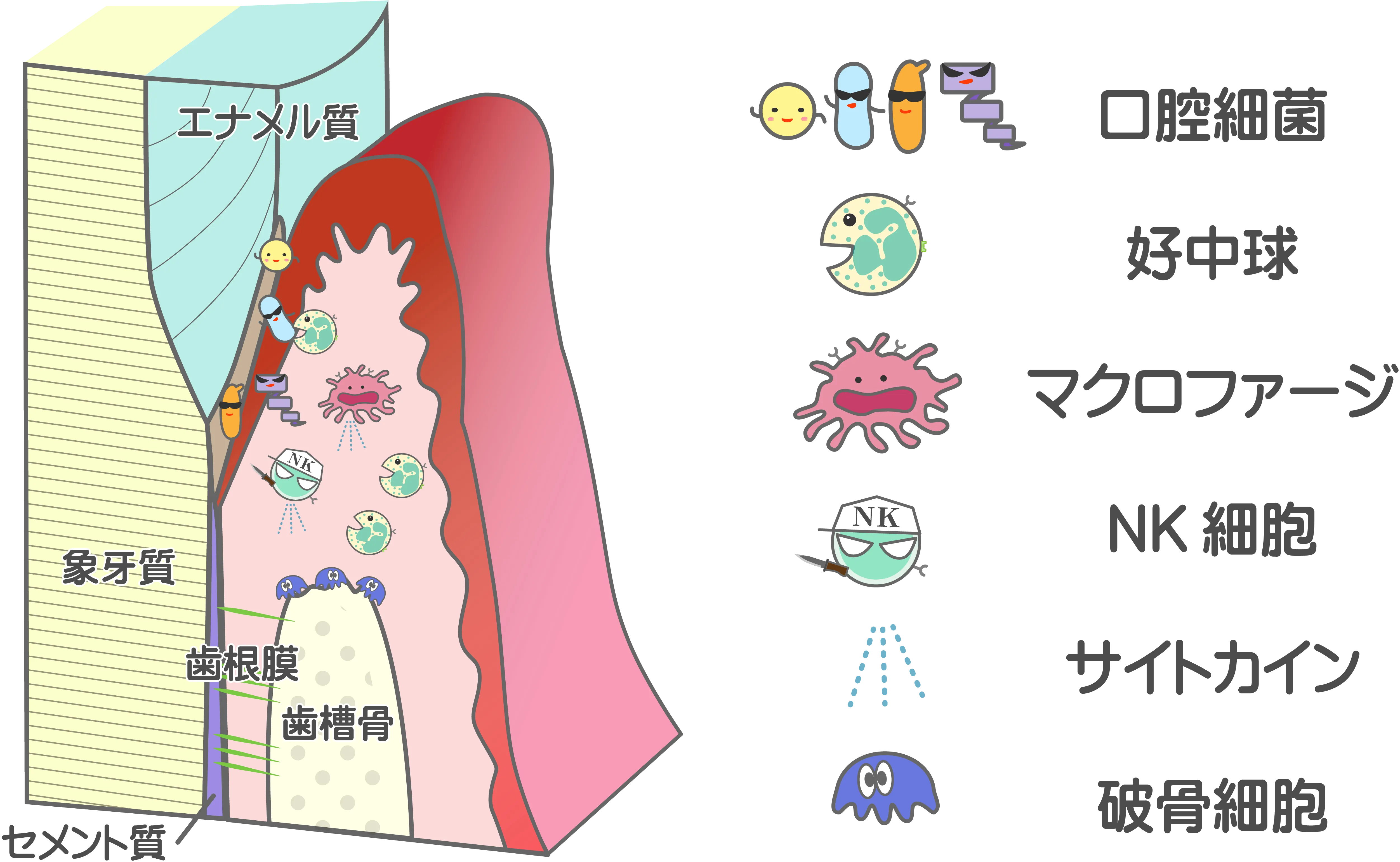 歯周病が発生したイラスト
