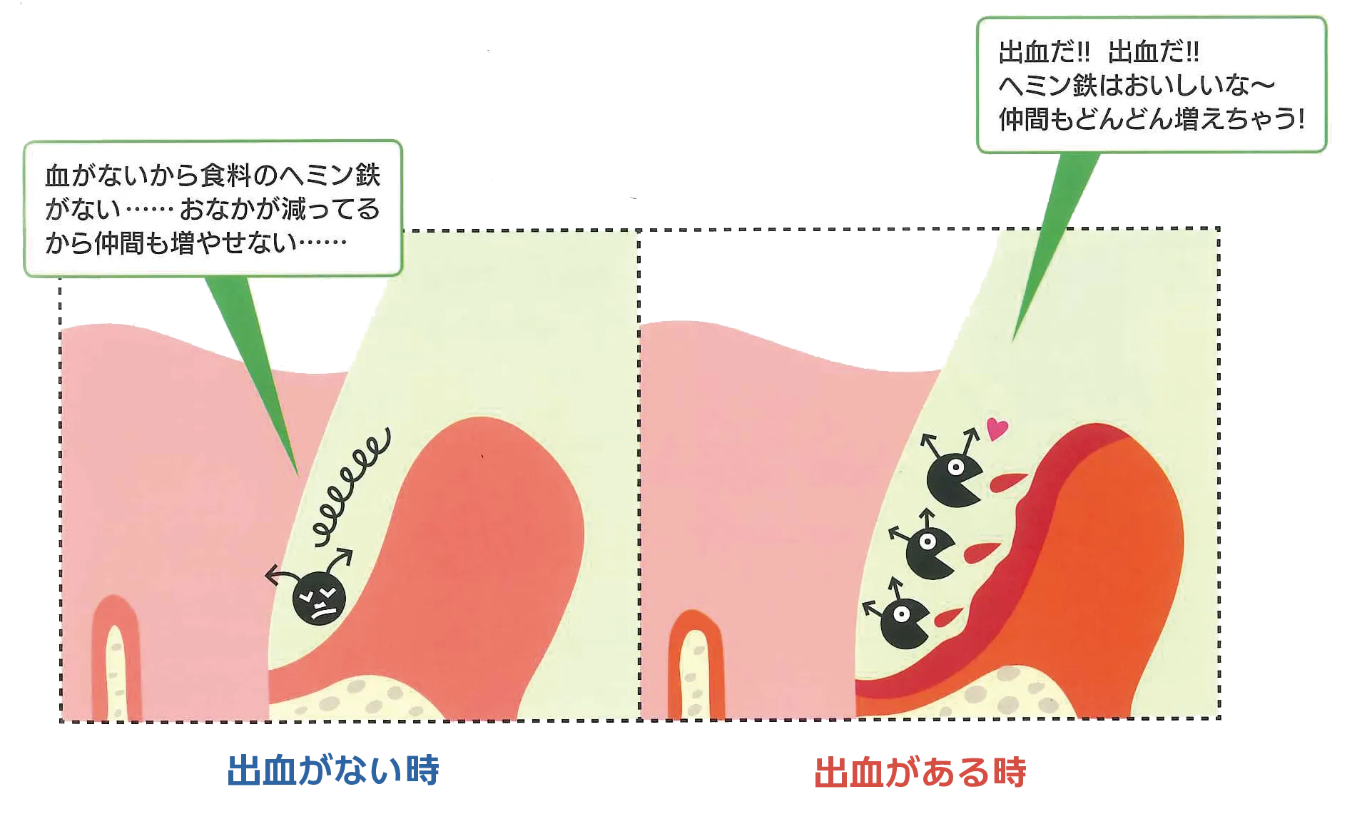歯周病が発生したイラスト