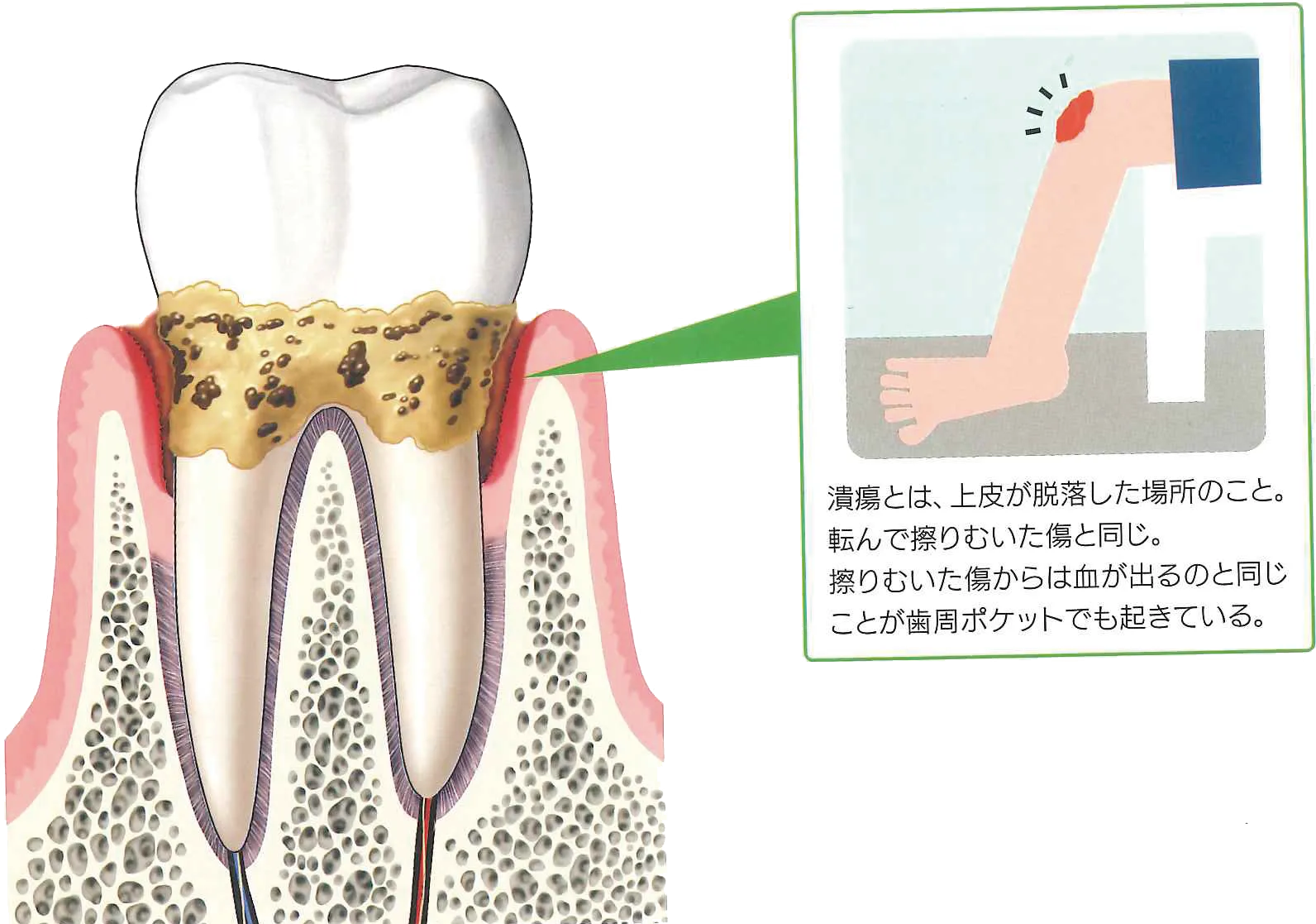 歯周病が発生したイラスト