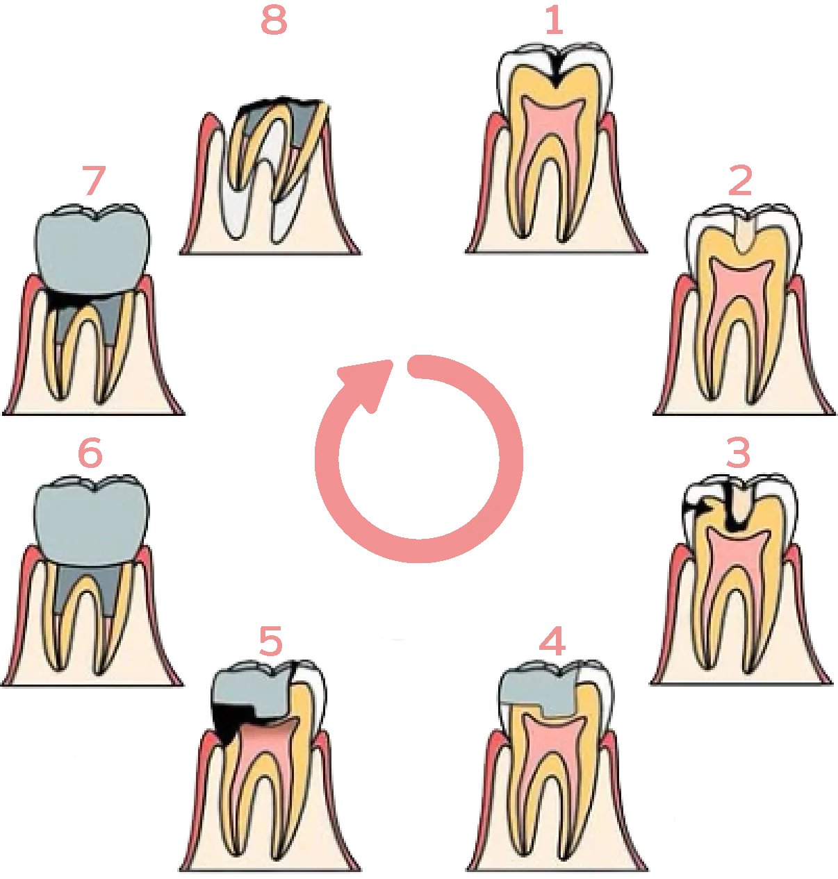 虫歯を削り始めてから抜歯までのイラスト