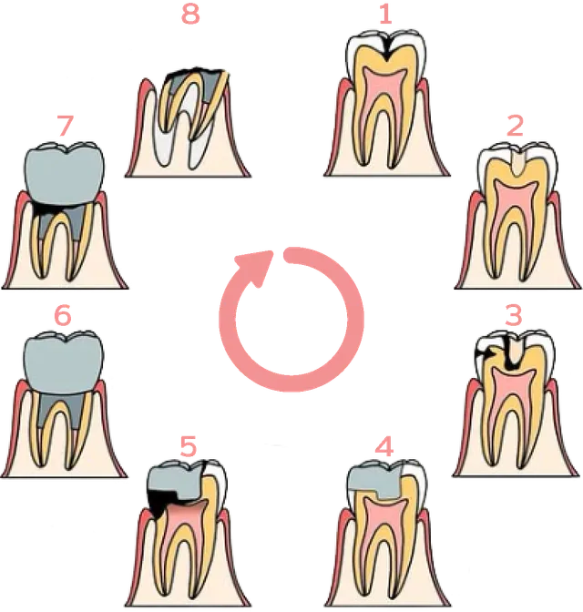 歯を削ってから歯を失うまでのサイクル